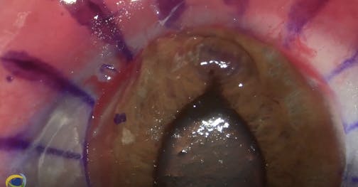 Penetrating Keratoplasty on a Perforated Cornea
