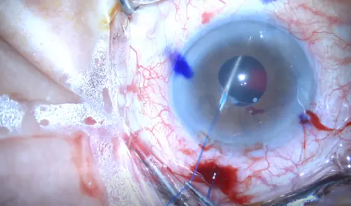 6-0 Prolene Flanged Technique for Scleral Fixation