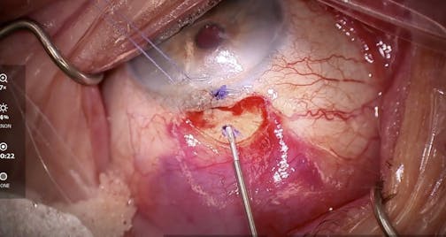 Combining Technologies: Durysta and Xen Gel Stent