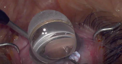Canaloplasty With iTrack