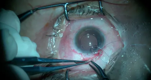Conjunctival Closure Technique After Glaucoma Surgery