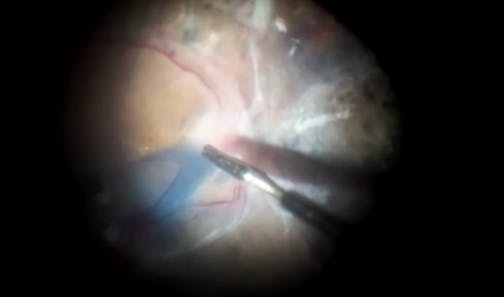 Double Peel for Fibrovascular Tractional Epiretinal Membrane in Severe Diabetic Retinopathy
