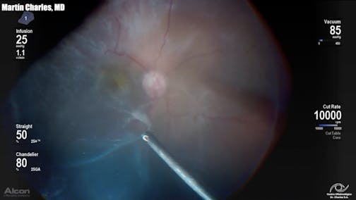 Extensive ILM Peeling in PVR