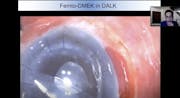 Ziemer Satellite Symposium: ESCRS 2020 | FEMTO LDV Z8