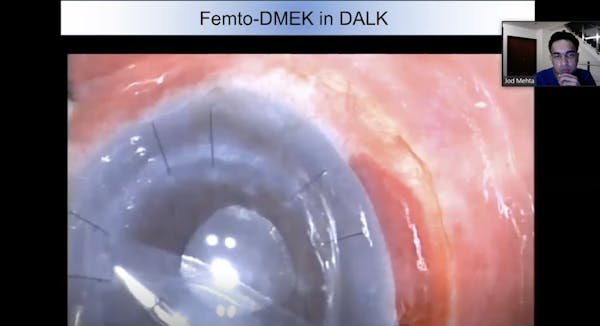 Ziemer Satellite Symposium: ESCRS 2020 | FEMTO LDV Z8 thumbnail