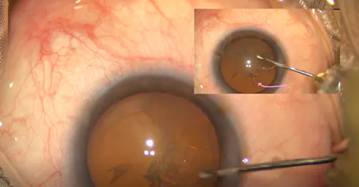 Unusual Posterior Capsule Rupture