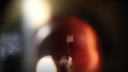 Laser Floater Treatment: Using Reflex Technology to Visualize the Opacity