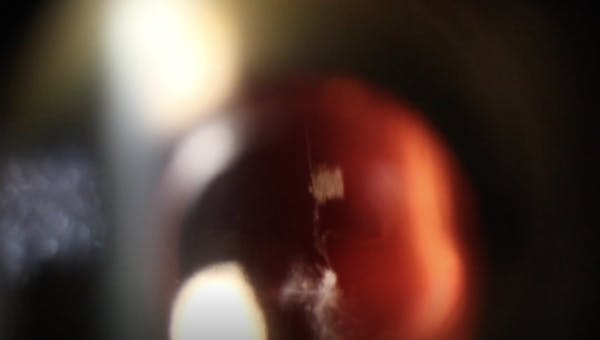 Laser Floater Treatment: Using Reflex Technology to Visualize the Opacity thumbnail