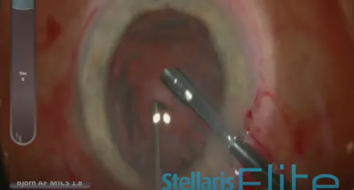 Optimizing Safety and Efficacy in a Combined Cataract and Glaucoma Case