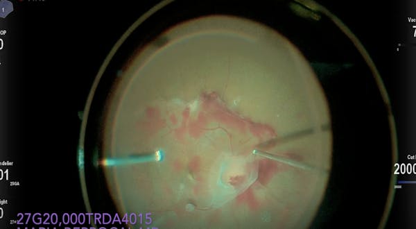 RD Repair With the Lift-and-Shave Technique thumbnail