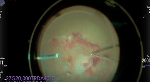 3D Retinal Detachment Repair With the Lift-and-Shave Technique