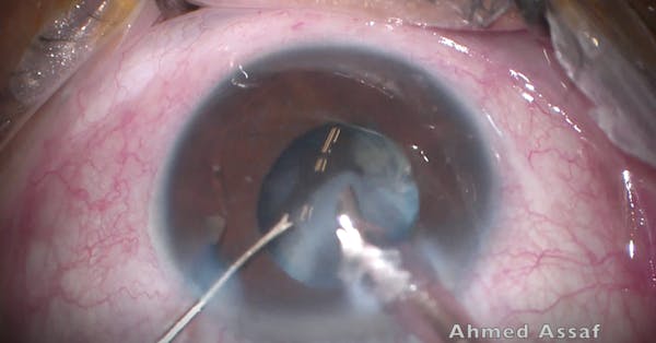 Phacoemulsification Complication in an Eye With a White Cataract thumbnail