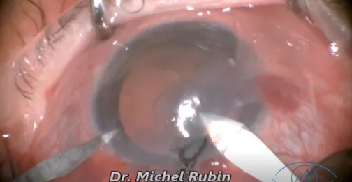 Surgery in Eye With Advanced Glaucoma and Cataract