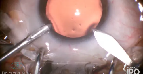 Mastering Cataract Incisions