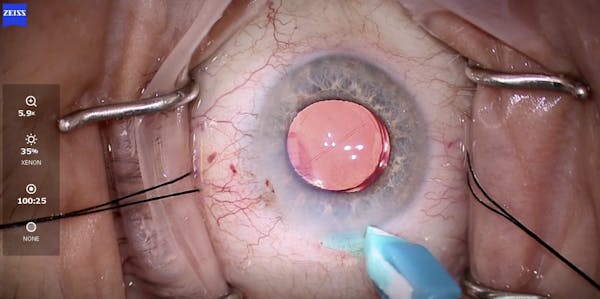 ReSure and Dextenza: Using Technology to Maximize Patients' Outcomes thumbnail