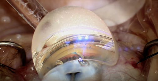 Combining Mechanisms: Viscodilation and Stenting