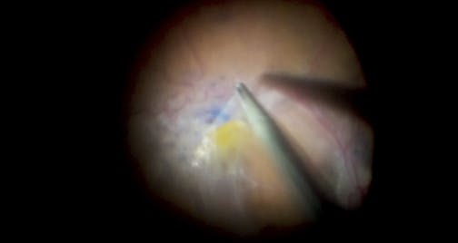 Triple En Bloc Peel for Macular Pucker With Taut Hyaloid