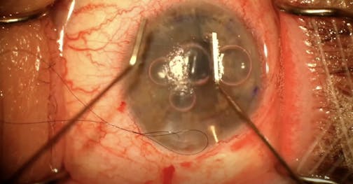 DMEK in the Presence of a Previous Glaucoma Drainage Device