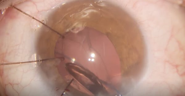Bag Fixation Double Flange Technique thumbnail