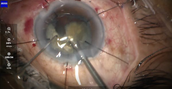 Cataract Surgery in an Eye With a Small Pupil and Phacodonesis thumbnail