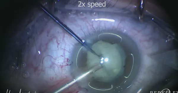 Iatrogenic Cataract Following Vitrectomy thumbnail