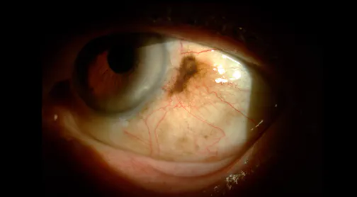 Endoret Conjunctival Primary Acquired Melanosis