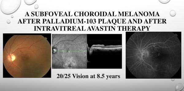 Intravitreal Injection Methods thumbnail