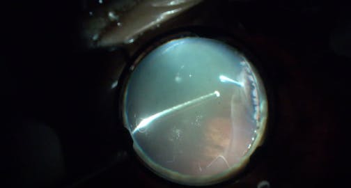 Management of Subretinal Trocar During Vitrectomy for Retinal Detachment