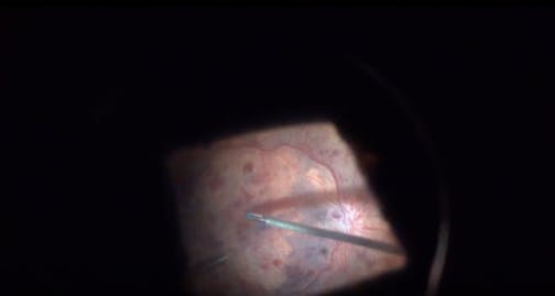 Central Retinal Vein Occulusion