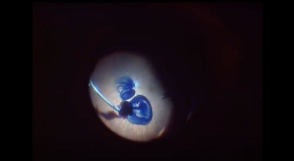Standard Technique for Full-Thickness Macular Holes thumbnail