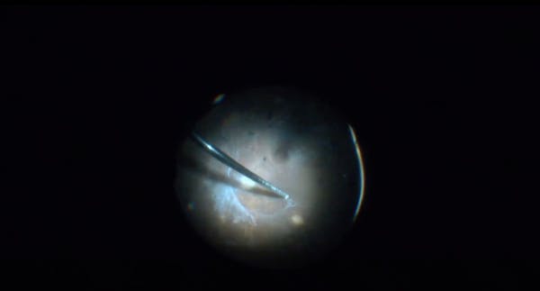 Tractional Retinal Detachment thumbnail