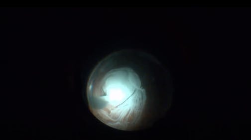 Endocryocoagulation for Retinal Macroaneurysm