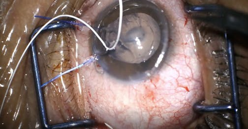 Traumatic Cataract With 4 Clock-Hour Iridodialysis and Zonulysis