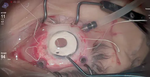 Custom Gore-Tex Prosthesis in Posttraumatic Aniridia and Aphakia