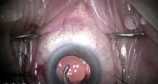 Evidence of Episcleral Blanching With Hydrus Microstent thumbnail