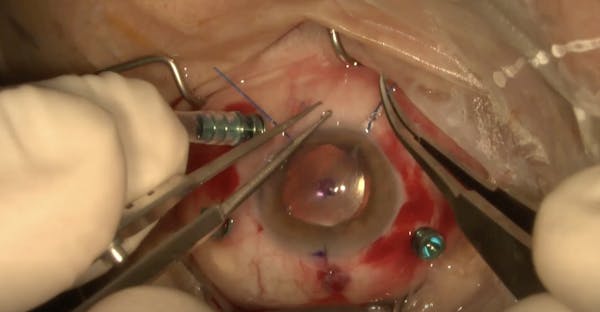 IOL Rescue With Yamane Technique thumbnail