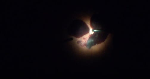 PDR-Related Subhyaloid Hematoma