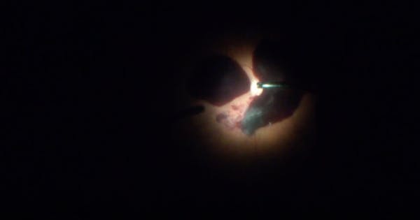 PDR-Related Subhyaloid Hematoma thumbnail
