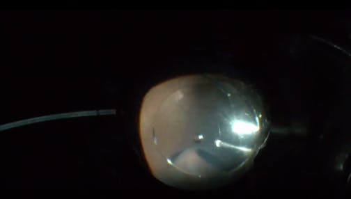 Retinal Hole Hidden Behind Triamcinolone-Stained Cortical Layer