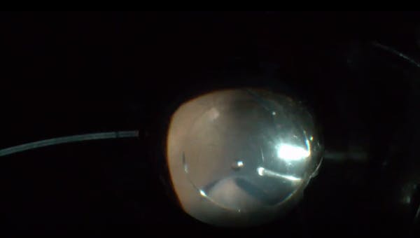 Retinal Hole Hidden Behind Triamcinolone-Stained Cortical Layer thumbnail