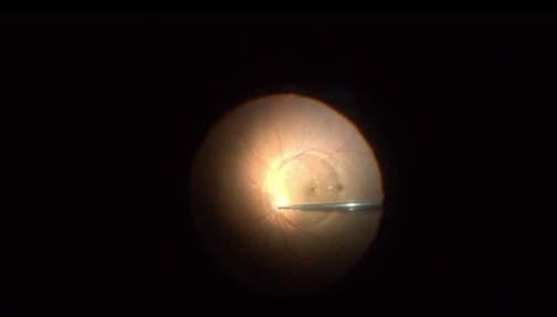 Lens-Sparing Vitrectomy for Rhegmatogenous Retinal Detachment
