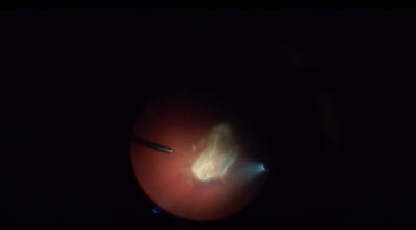 Peripapillary Tractional Retinal Detachment thumbnail