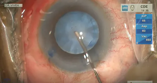 Phacoemulsification in Intumescent Cataract