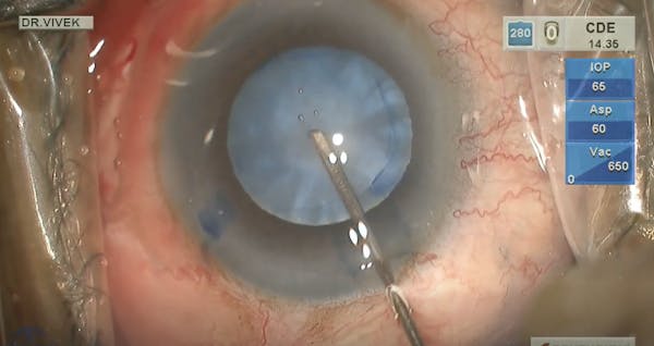 Phacoemulsification in Intumescent Cataract thumbnail