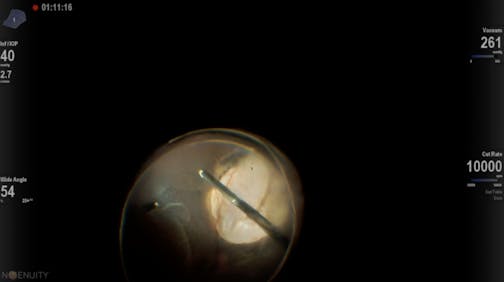 Coloboma Retinal Detachment Repair