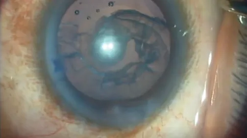 Posterior Polar Cataract