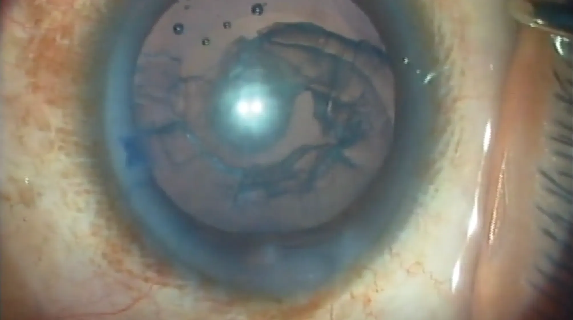Posterior Polar Cataract - Eyetube
