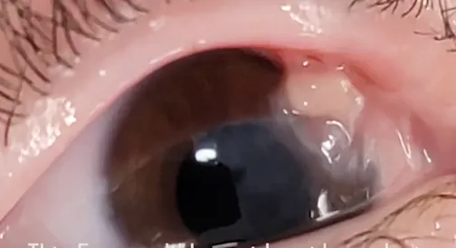 Unusual Lid Adhesions to the Globes