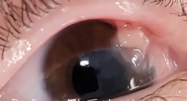 Unusual Lid Adhesions to the Globes thumbnail