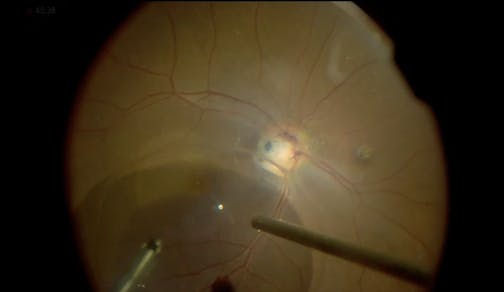 Optic Nerve Pit Maculopathy